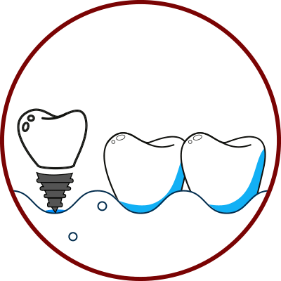 Dental implant